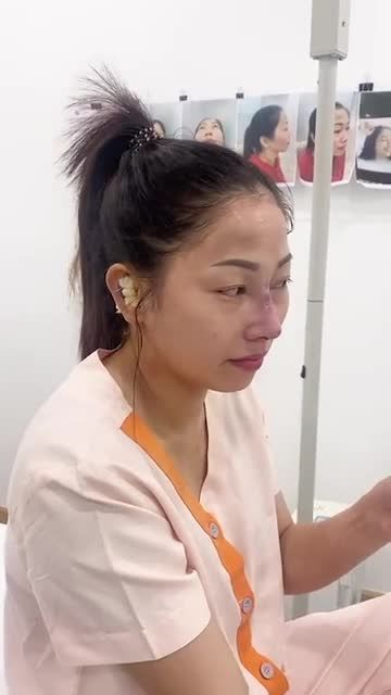 Kết quả sau 2h nâng mũi