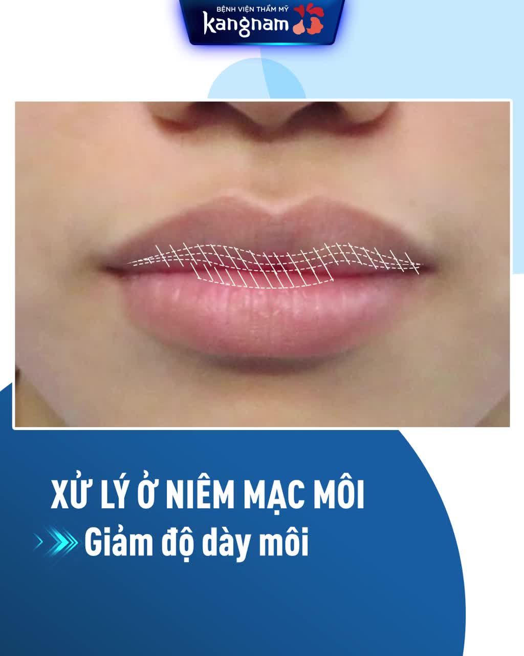 Môi dày hóa nhỏ xinh - Viền môi cong mềm mại nữ tính!