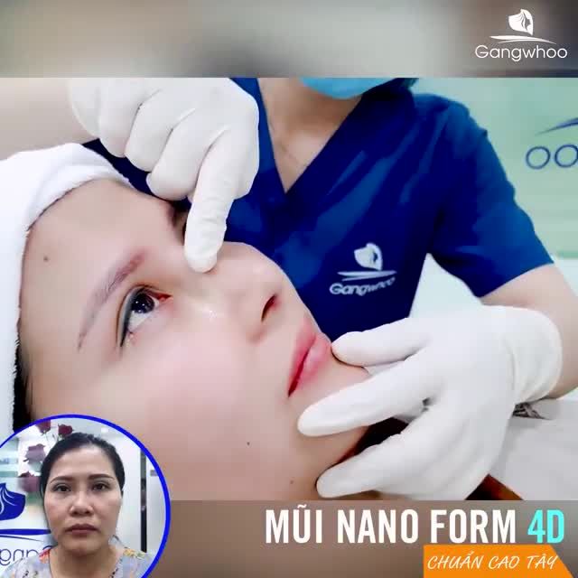 NÂNG MŨI CẤU TRÚC NAOFORM 4D - 45 PHÚT NHẬN NGAY DÁNG MŨI SANG