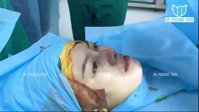 NẾU BIẾT NÂNG MŨI KHÔNG ĐAU NHƯ BẠN NGHĨ. LIỆU BẠN CÓ ĐI LÀM SỚM HƠN KHÔNG?