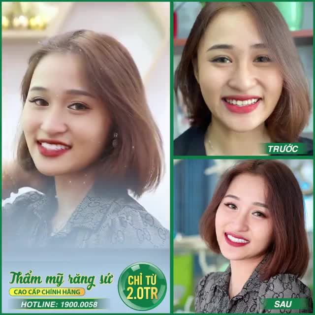 THẨM MỸ RĂNG: SÁNG NỤ CƯỜI – SANG GƯƠNG MẶT