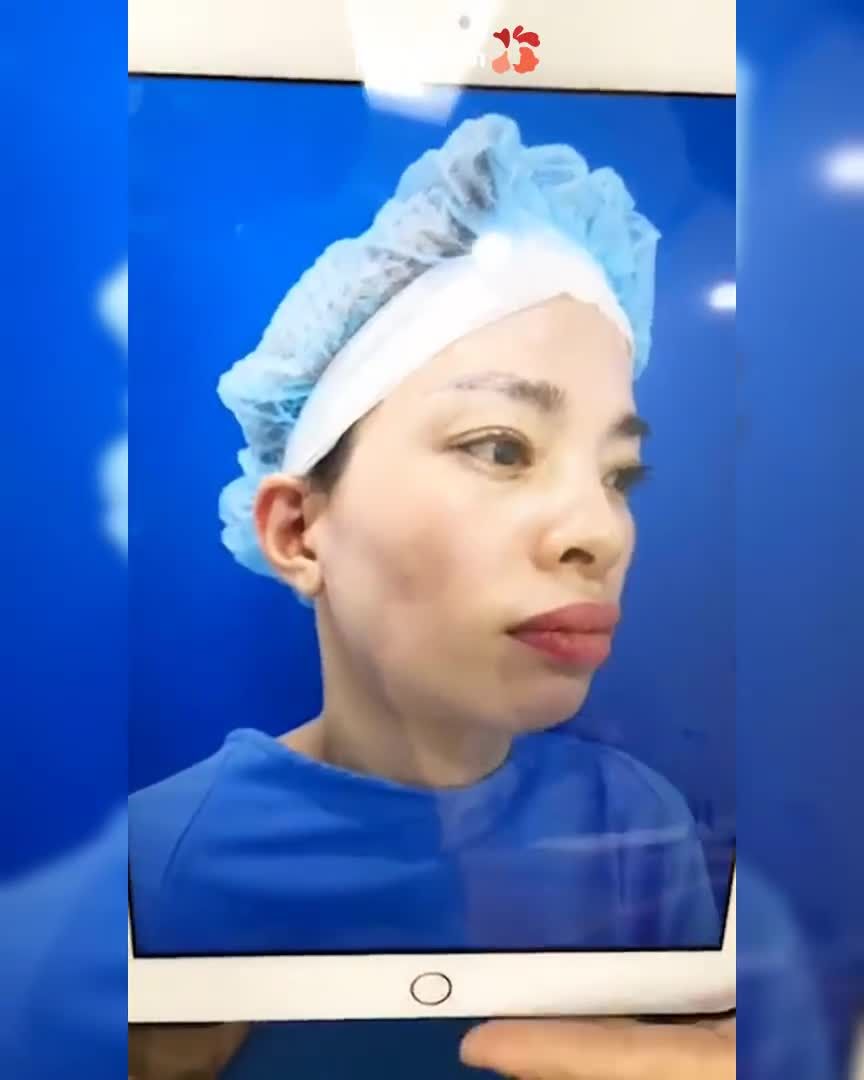 Nữ khách hàng xúc động vì gương mặt quá hoàn hảo sau 10 ngày CHỈNH HÀM HÔ