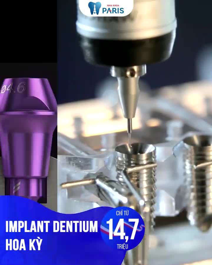 Trồng răng implant giá tốt nhất năm OFF 20%