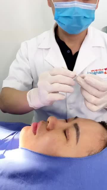 Quy trình cắt chỉ mí sau 5 ngày phẫu thuật