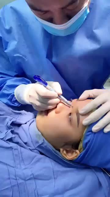 Hiểu hết về Nâng mũi K-nose: Công nghệ mới có gì mới???