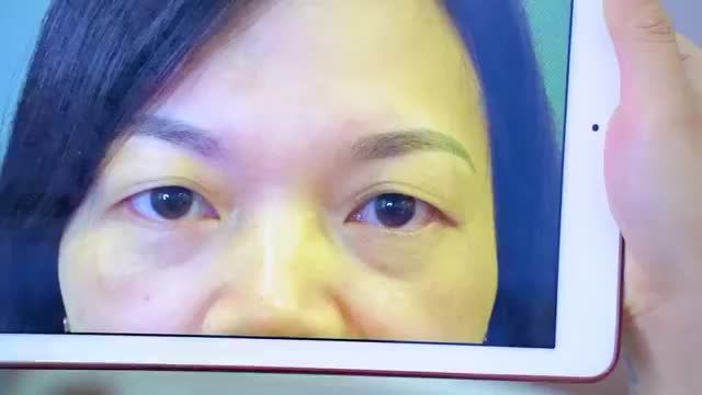 Sau 3 năm Cắt mí nếp mí đẹp tự nhiên như thế nào? Mời quý khách hàng cùng chiêm ngưỡng