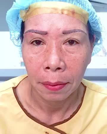 Nâng cung mày giải pháp xóa bỏ tình trạng da chùng sụp mí u buồn già nua, che khuất tầm nhìn hiệu quả - Mời quý khách hàng cùng theo dõi kết quả