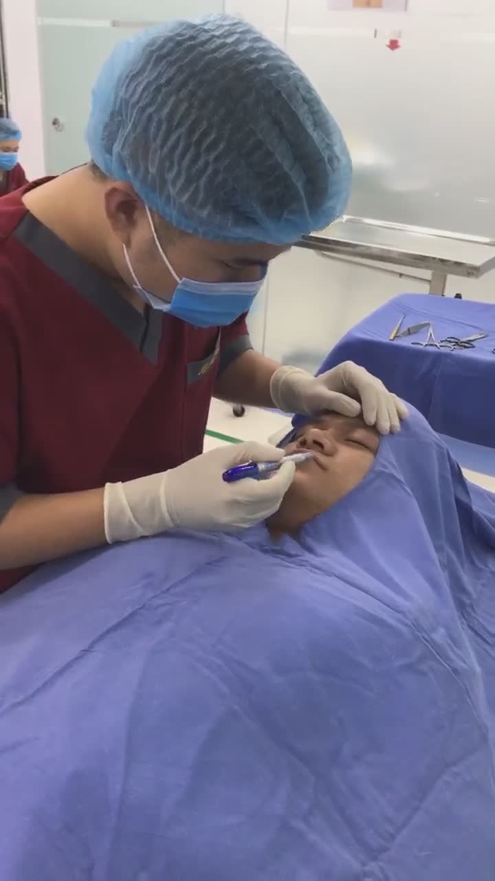 Bác sĩ thực hiện quy trình đo vẽ thu gọn cánh mũi, cải thiện dáng mũi!