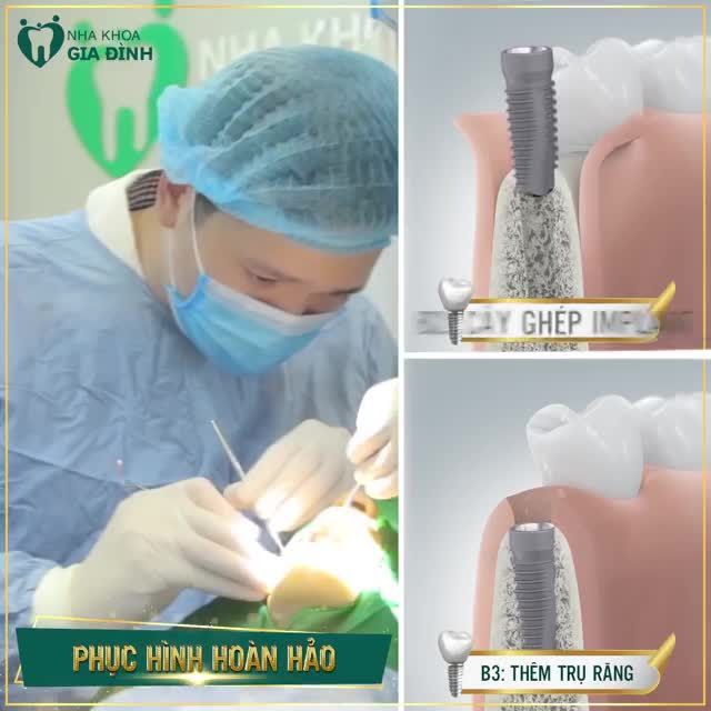 CẤY GHÉP IMPLANT: GIẢI PHÁP THAY THẾ RĂNG MẤT HOÀN HẢO, CHO NỤ CƯỜI TOÀN DIỆN