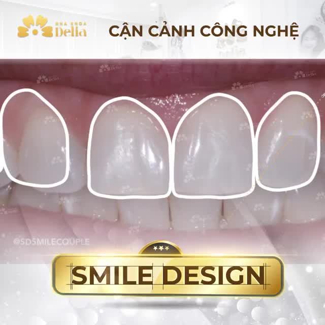 CÔNG NGHỆ THIẾT KẾ NỤ CƯỜI SMILE DESIGN - TÁI TẠO NỤ CƯỜI CHO RIÊNG BẠN!