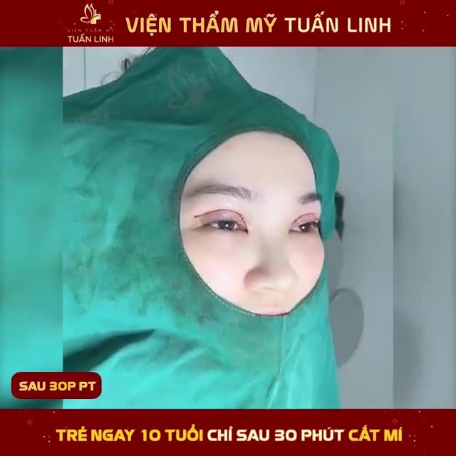 TRẺ NGAY 10 TUỔI - LẤY LẠI THANH XUÂN CHO ĐÔI MẮT CHỈ SAU 30 PHÚT