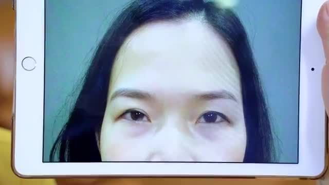 Dr.Hải Lê xử lý tất cả các trường hợp Mí lỗi hỏng giúp khách hàng lấy lại sự tự tin và nụ cười trên môi