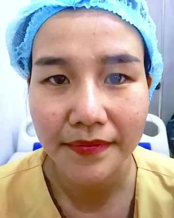 Mắt nhỏ u buồn, sụp mí khắc phục như thế nào sau tiểu phẫu Cắt mí