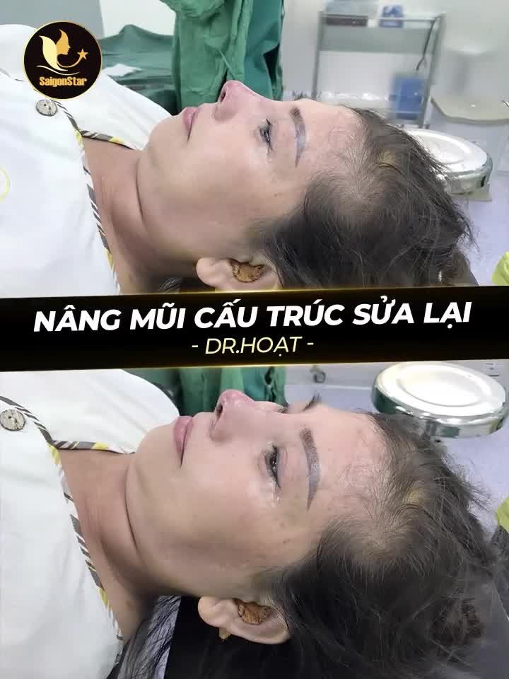 KHẮC PHỤC "DÁNG MŨI XẤU" TỪ BS THIẾU THẨM MỸ