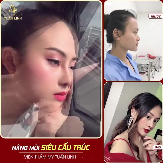 NÂNG MŨI SIÊU CẤU TRÚC THAY ĐỔI KHUÔN MẶT BẠN NHƯ THẾ NÀO ???