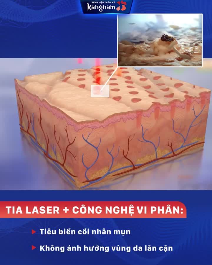 Mụn thịt quanh mắt Mất thẩm mỹ Mất tự tin