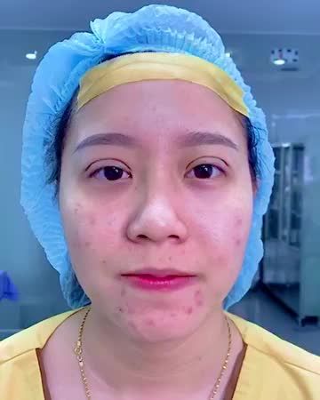 Xóa bỏ tự ti vì đôi mắt nhỏ u buồn sau 45 phút thực hiện Cắt mí tại Dr.Hải Lê chi nhánh TP.HCM Mời quý khách hàng cùng theo dõi