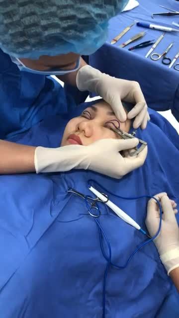 Phân tích đo vẽ ca Cắt mí trên Plasma số 28 trong ngày
