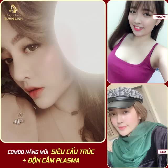 NÂNG MŨI + ĐỘN CẰM CHO KHUÔN MẶT XINH SANG TUYỆT ĐỐI.