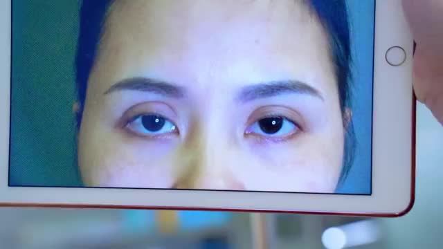 TẠI SAO KHÁCH HÀNG CHỌN DR.HẢI LÊ SỬA MÍ SAU KHI GẶP NHỮNG BIẾN CHỨNG LỖI HỎNG KHÔNG MONG MUỐN