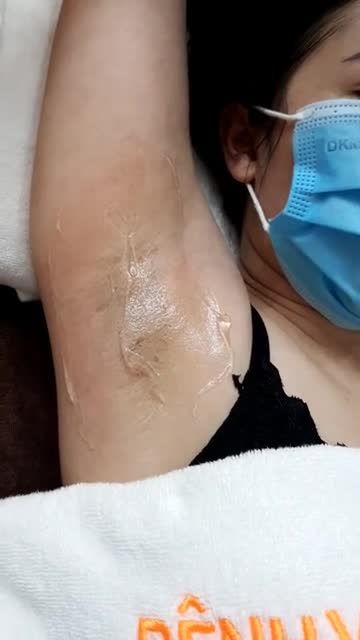 TRIỆT LÔNG SIÊU HỜI, CHỊ EM CÙNG TỚI