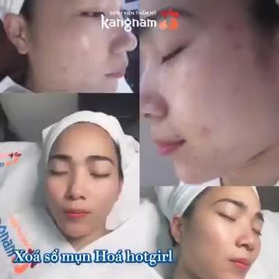 "Xoá sổ" mụn sẹo Da căng bóng hoá hotgirl
