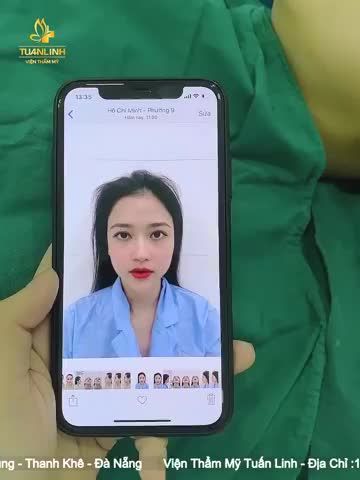 Khách hàng nâng mũi cấu trúc sau 90 phút phẫu thuật thay đổi như thế nào?