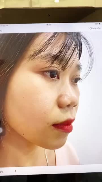 Khi nào nên bọc cân cơ thái dương (fascia) trong nâng mũi?