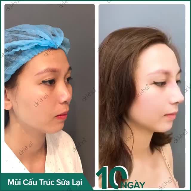 NÂNG MŨI - TIÊM FILLER: ĐÂU MỚI LÀ GIẢI PHÁP THẬT SỰ?