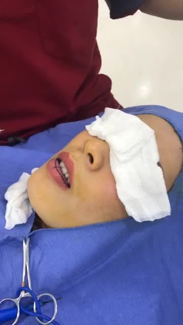 Phân tích đo vẽ thu mỏng môi dưới  - Tạo nét môi quyến rũ cùng Kangnam