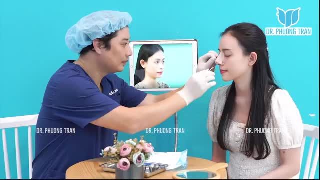 BÁC SĨ TRỰC TIẾP THÁO NẸP CHO KHÁCH HÀNG SAU 7 NGÀY NÂNG MŨI SỤN SƯỜN