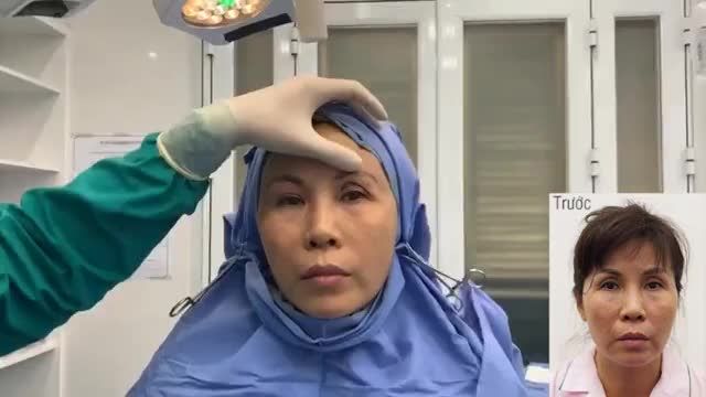 Dr. Minh Phạm phân tích ca cấy mỡ mí và thái dương