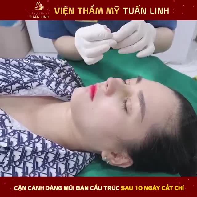 MŨI BÁN CẤU TRÚC SAU 10 NGÀY TẠI TUẤN LINH