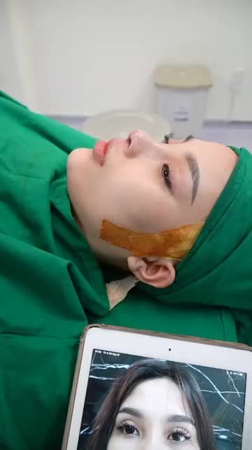 CA NÂNG MŨI CẤU TRÚC SỬA LẠI CHO KHÁCH HÀNG MINH NGUYỆT VỪA THỰC HIỆN XONG