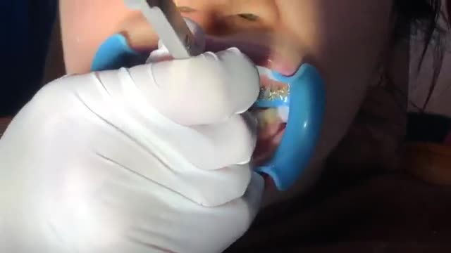 Gắn mắc cài cho bệnh nhân răng THƯA VÀ CHÌA