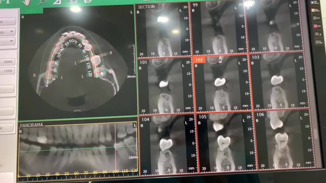 KHÔI PHỤC RĂNG ĐÃ MẤT NHANH CHÓNG - AN TOÀN - KHÔNG BIẾN CHỨNG