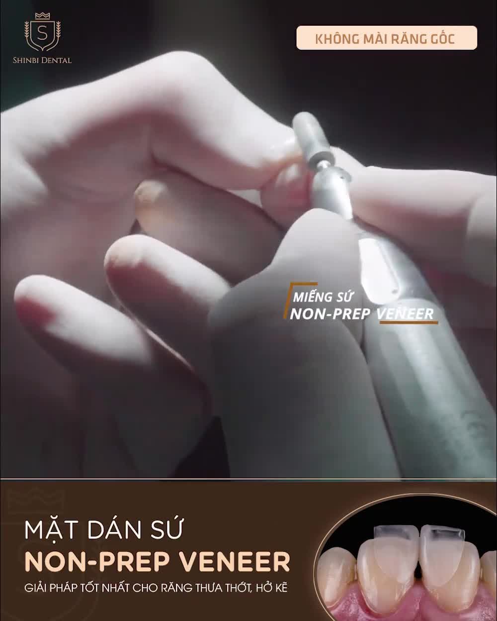 MẶT DÁN SỨ NON-PREP VENEER: GIẢI PHÁP TỐT NHẤT CHO RĂNG THƯA, HỞ KẼ
