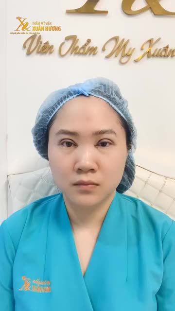 CẮT MÍ + MỞ GÓC MẮT NGAY KHI VỪA THỰC HIỆN XONG: NẾP MÍ MỚI ĐỀU ĐẸP, KHUÔN MẮT TO ĐỀU