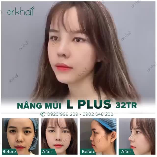 NGỠ NGÀNG VỚI DÁNG MŨI CẤU TRÚC CHỈ SAU 5 NGÀY