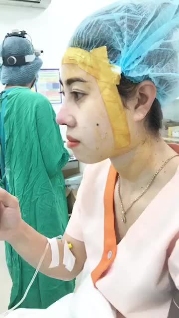 Sóng thấp - đầu mũi ngắn - mô đầu mũi to