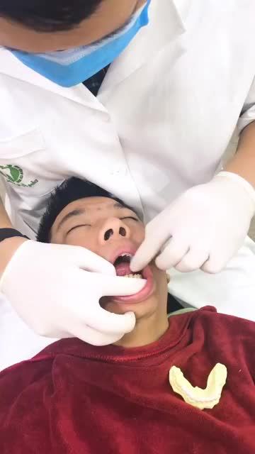 ƯỚM THỬ VENEER SỨ CHO MỘT VỊ KH NAM
