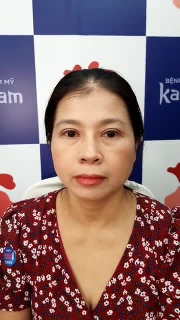Thay đổi ngoạn mục với dịch vụ cắt mí trên plasma tại bệnh viện Kangnam 1 tháng sau phẫu thuật