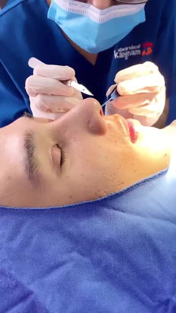 Quy trình cắt chỉ cho nam khách hàng làm combo cắt mí nâng mũi...
