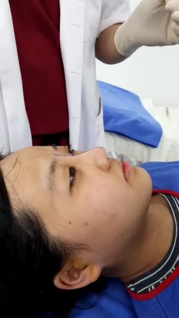 Quy trình Nẹp Mũi K Nose tại Kangnam