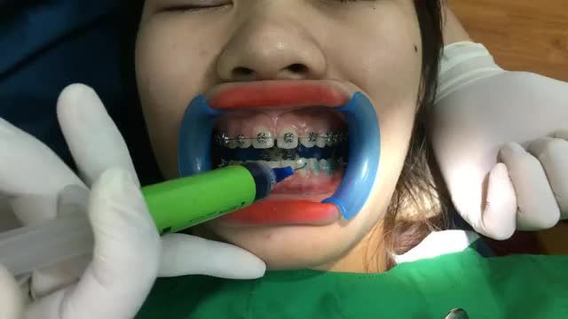 Gắn mắc cài hàm dưới cho bạn Lý tại nha khoa Thuỳ Anh