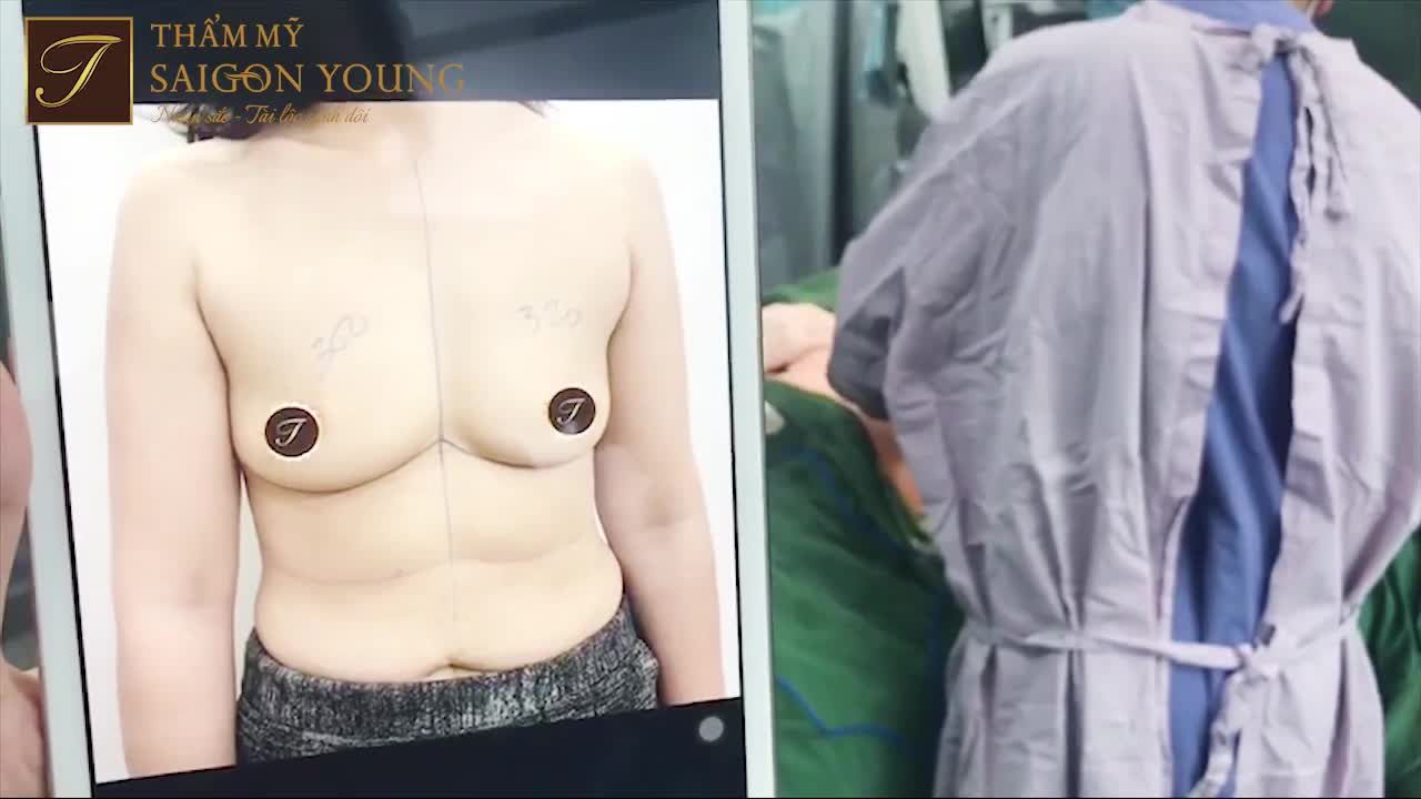 Khách hàng hôm nay đến với Thẩm mỹ Saigon Young bác sỹ Tươi Sài Gòn là chị H. 39 tuổi, đã sinh 02 con.