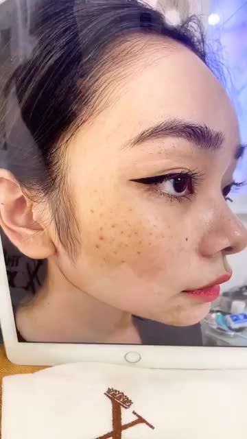 Khách hàng quá hài lòng với kết quả điều trị tan nhang chỉ sau 1 buổi. Ưu đãi đến 60% cho dịch vụ trị tàn nhang tại TMV Xuân Hương