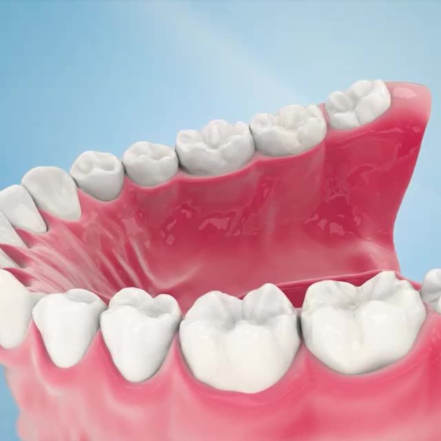 Nên chọn bọc răng sứ hay dán sứ Veneer?