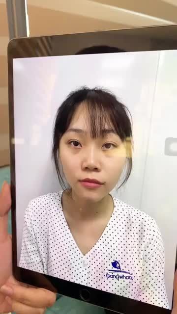 Tái khám khách hàng nâng mũi Nanoform 4D sau 1 tháng.