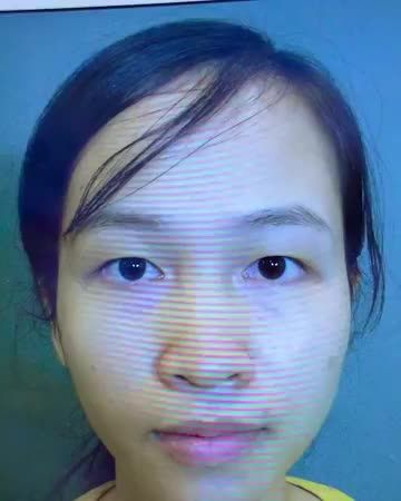 Mí khó, mí xấu cỡ nào, Dr.Hải Lê đều có thể khắc phục xử lí. Một ca cắt mí siêu khó nhưng mang tới kết quả siêu đẹp
